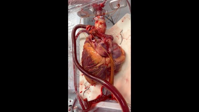 Tak wygląda ludzkie serce oczekujące na przeszczep [WIDEO]