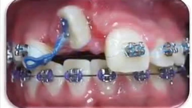 Aparat ortodontyczny w akcji!