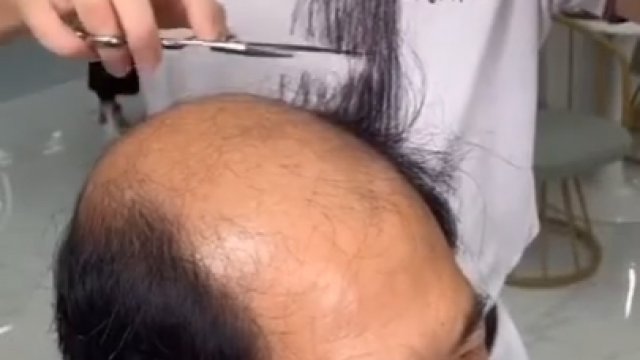 Chiński sposób na łysinę