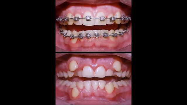 Tak właśnie działa aparat ortodontyczny do prostowania zębów [WIDEO]