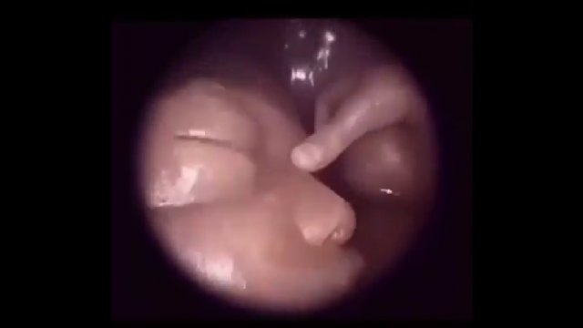 Wygląd płodu podczas fetoskopii. Niezwykłe nagarnie z wnętrza łona matki [WIDEO]